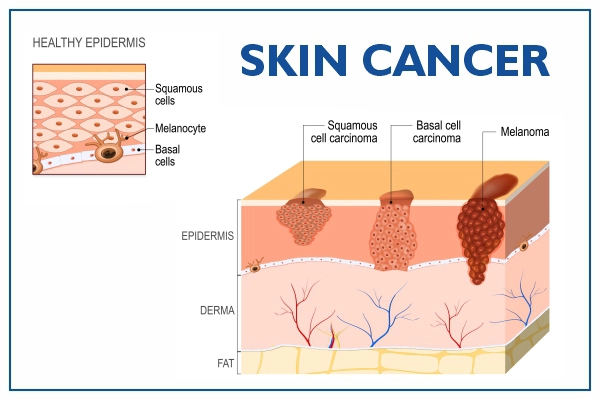 skin-cancer-overview